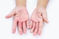 コロナ禍で“主婦湿疹”に悩む人が急増 最大の敵は「終わりのない家事」