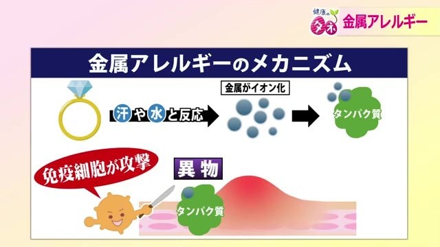 金属アレルギー発生のメカニズム