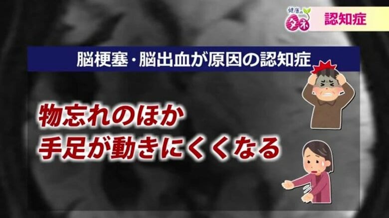 「寒いと集中力が低下」若い世代も要注意…冬の高血圧が招く将来の認知症リスク　“脳に優しい”4つの生活習慣｜FNNプライムオンライン