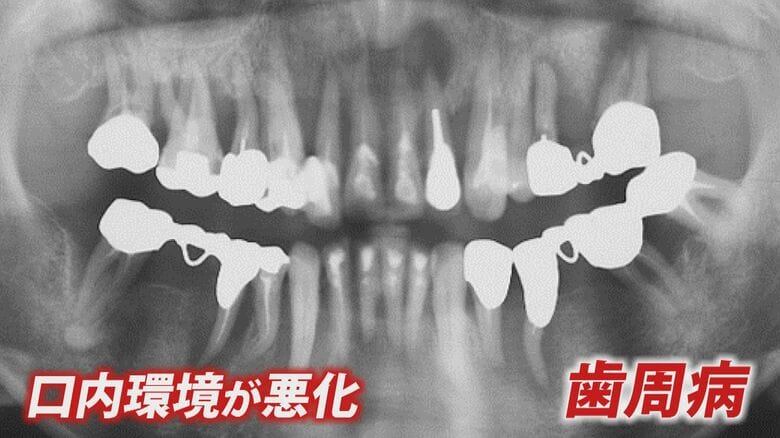 30代から急増「歯茎からちょっと血が」が歯周病のスタート 静かに進む"サイレントディジーズ" 全身疾患につながる恐れも|FNNプライムオンライン