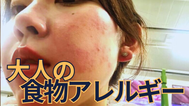 大好物が突然…“大人の食物アレルギー”が増加　食べるだけじゃない「触れる」も発症の原因に　手袋や保湿で予防を　｜FNNプライムオンライン