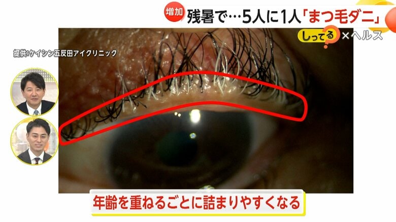 齢を重ねるごとに詰まりやすくなるという目の際にある油の線