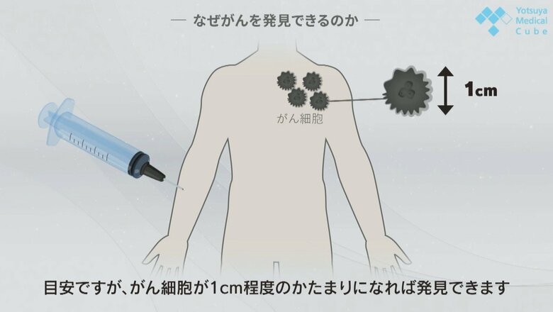 がん細胞が1センチ程度になれば発見（提供：四谷メディカルキューブ）