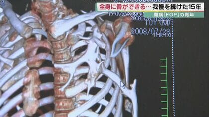 全身の筋肉に骨ができる難病「FOP」15年以上闘い続ける青年 体へ