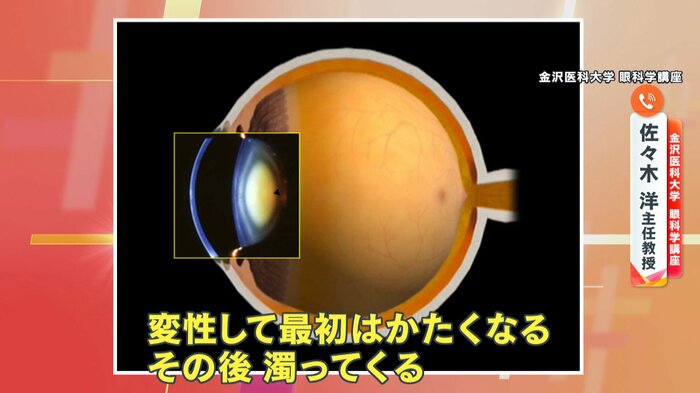 水晶体は最初は変性してかたくなり、その後濁る