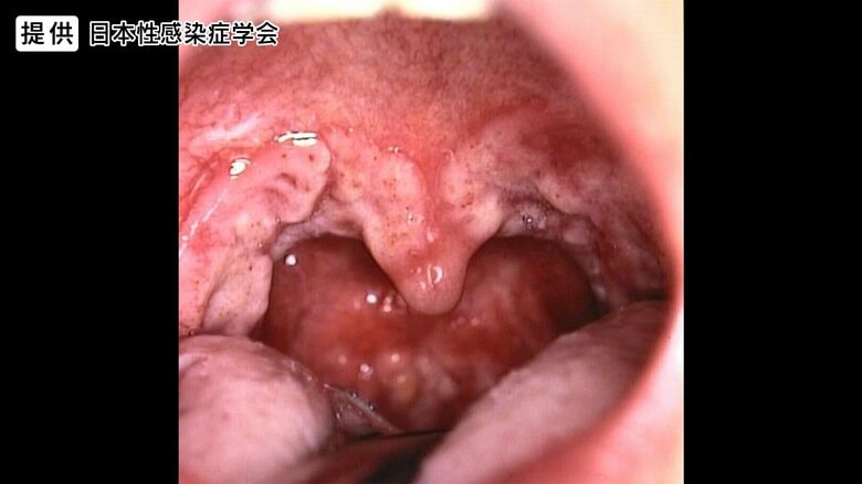 提供：日本性感染症学会