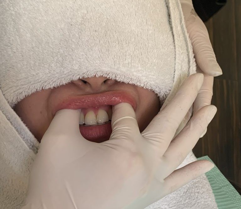 リフトアップ効果がある歯肉マッサージ（提供：アンチエイジングデンタルクリニック恵比寿）