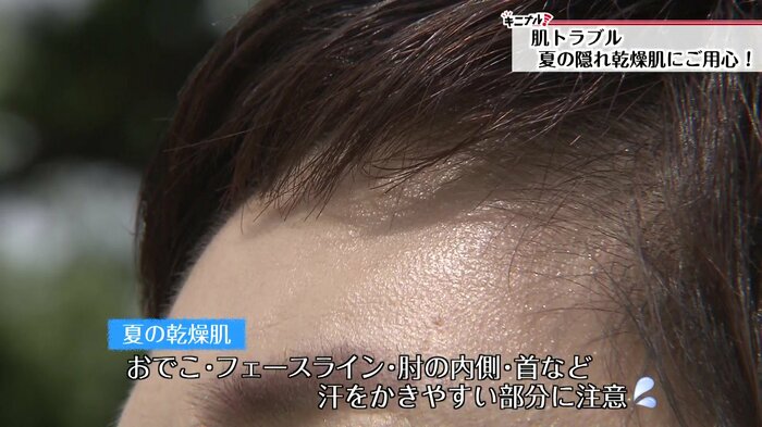 おでこやフェイスライン、汗がよくたまる肘や首に症状が多い
