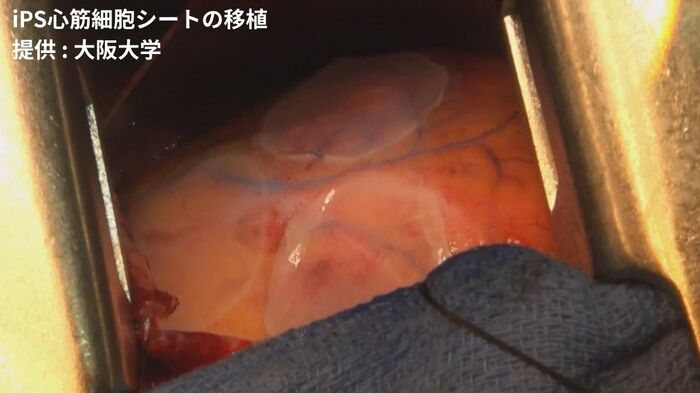 iPS心筋細胞シートの移植 提供:大阪大学