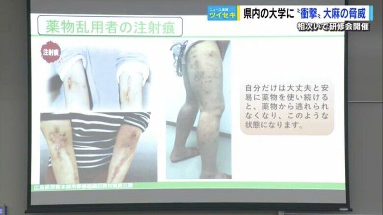 研修会で使われた薬物乱用者の注射痕の写真