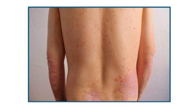 一人で抱えず医師とコミュニケーションを取ることを大事にしよう（画像：アムジェン株式会社）