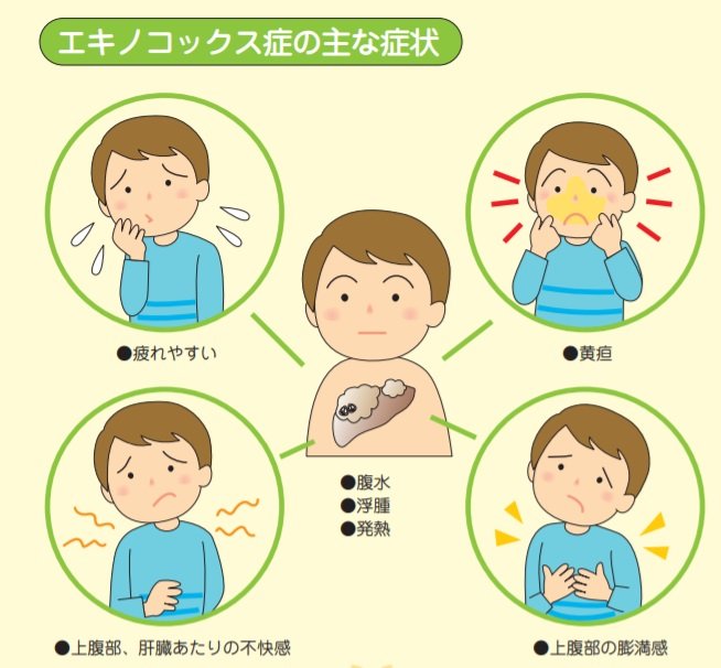 エキノコックス症の主な症状(出典:北海道保健福祉部「エキノコックス症かからないためのQ&A」)