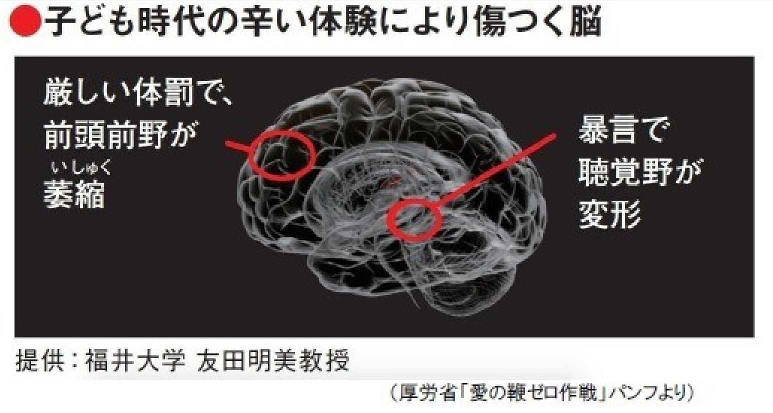スポーツ指導での体罰が 子どもの脳を破壊 画像で判明した異常な 萎縮 変形