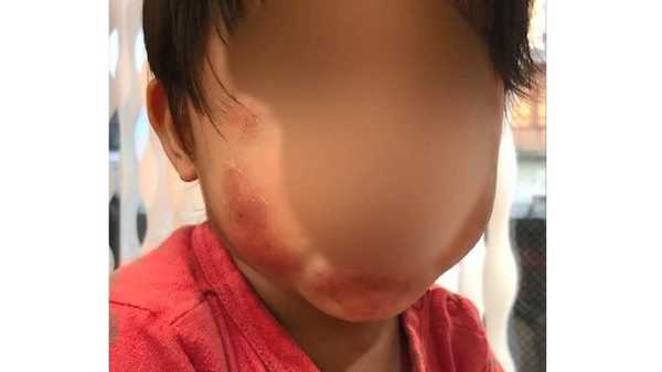 落書きを落とすため 保育士が3才児の顔を汚れ落としのスポンジでこする 全治1ヶ月のやけど 落書きを落とすため 保育士が3才児の顔を汚れ落としのスポンジでこする 全治1ヶ月のやけど