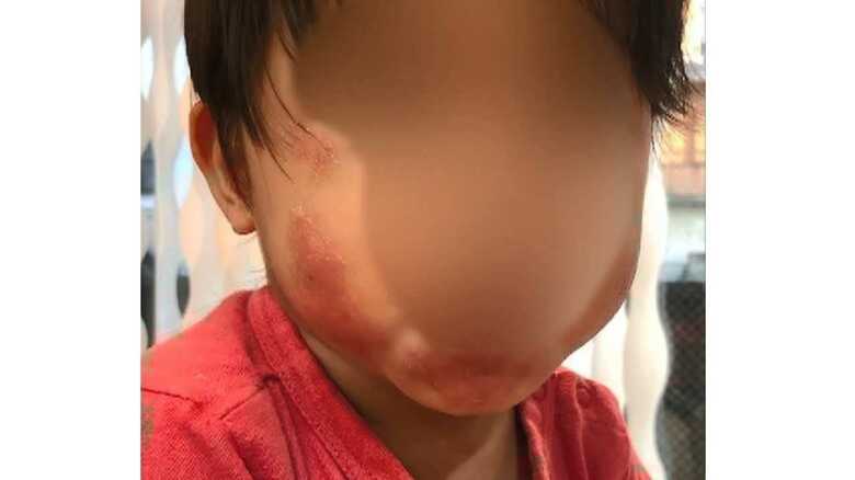 ｢落書きを落とすため｣保育士が3才児の顔を汚れ落としのスポンジでこする…全治1ヶ月のやけど｜FNNプライムオンライン