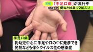 乳幼児を中心に流行…ウイルス性の感染症『手足口病』愛知と岐阜の患者数が2年ぶりに警報レベルを上回る