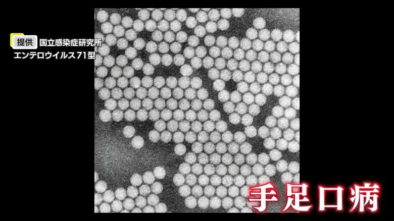 1シーズンに3回感染も？手足口病　5年ぶりの大流行は“枯れ木に火がついたような”状況　大人が重症化する理由は｜FNNプライムオンライン