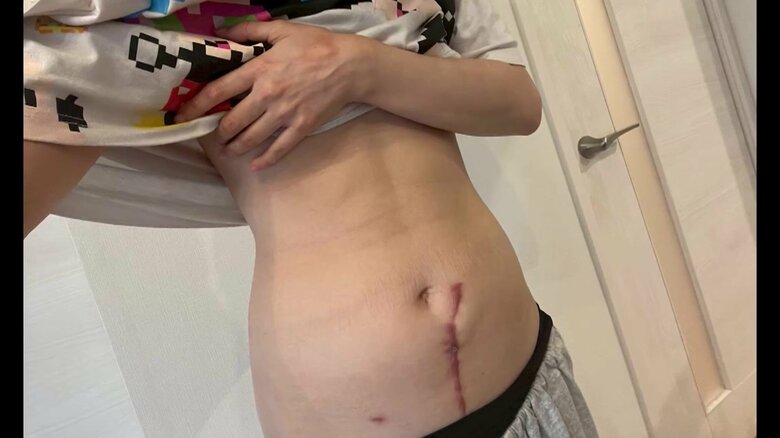 優美さんのお腹に残る手術の痕