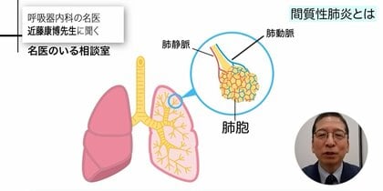 健康食品・カビ・羽毛などから発症することもある「間質性肺炎」新型コロナ重症化の要因にも…早期発見と予防法を医師が解説