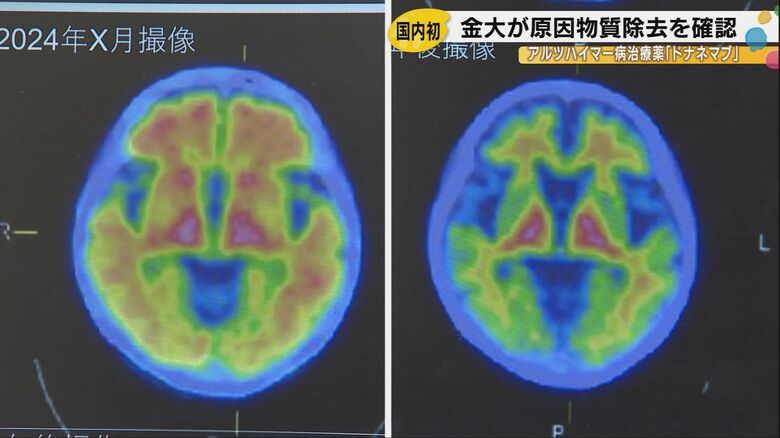 金沢大学が国内初確認、アルツハイマー治療薬ドナネマブで脳内原因物質が「見事に消えていた」|FNNプライムオンライン