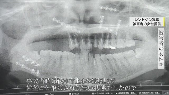 レントゲン写真（被害者提供）