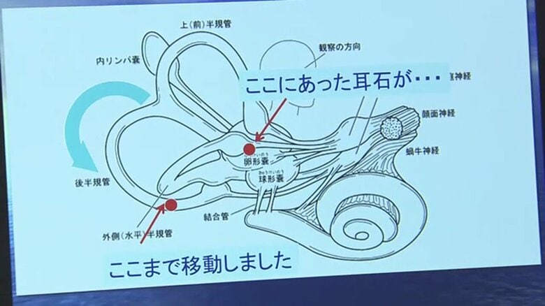 耳石が動くことでめまいが発生