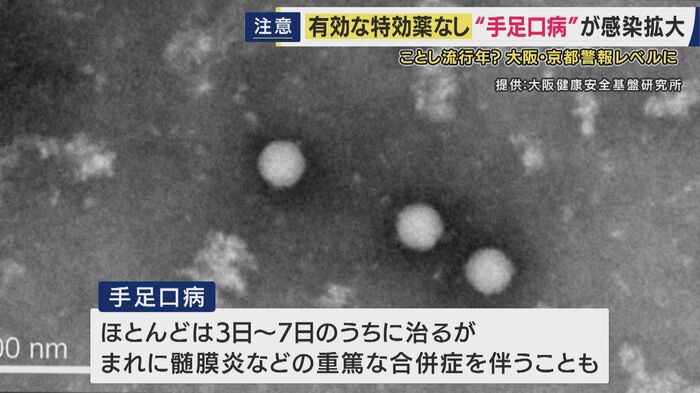 手足口病とは