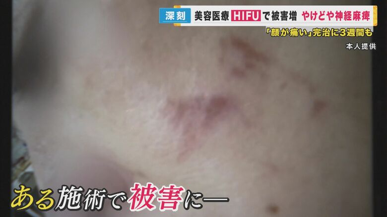 引っかかれたような赤い傷