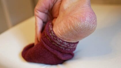 “ガサガサかかと”は削らず保湿が優先！保湿剤を塗るタイミングと“ひび割れ”時の正しい角質の削り方