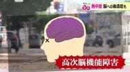 熱中症は大脳に後遺症のリスク　43度1時間以上で“溶け始め”高次脳機能障害に　ハンディファンは「大正解」と医師