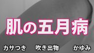 肌も五月病になる！？　新生活のストレスが引き起こす肌トラブル　適切なケアと“汗活”で夏への備えを　