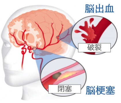 治療可能時間を“5倍拡大”に向けて　日本発の脳梗塞治療薬候補、ティムスが研究開発