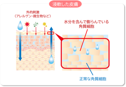 スキントラブルの調査結果を受け”皮膚浸軟”に着目した大人用紙おむつの開発を推進