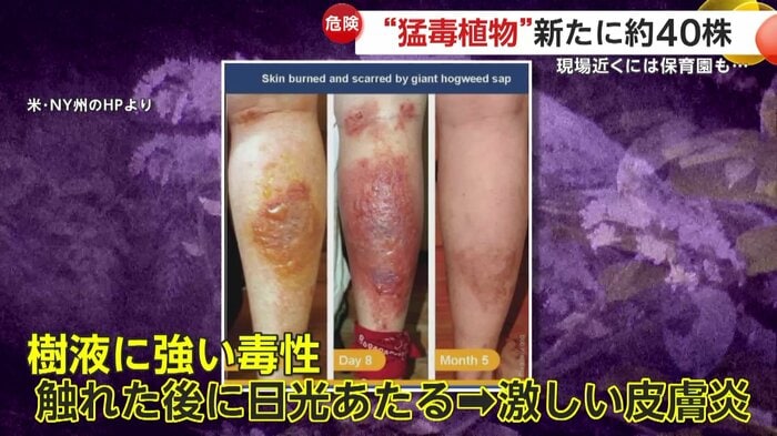 バイカルハナウドの被害を受けた人の症状
