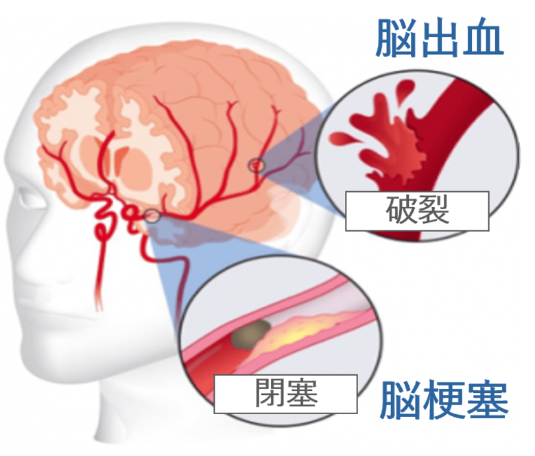 治療可能時間を“5倍拡大”に向けて　日本発の脳梗塞治療薬候補、ティムスが研究開発