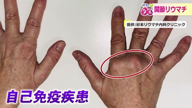 関節リウマチは自己免疫疾患の一つ
