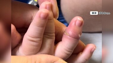 【注意喚起】「赤ちゃんの指が壊死しかけた…」SNSに母親が投稿 “ヘアターニケット症候群”とは？