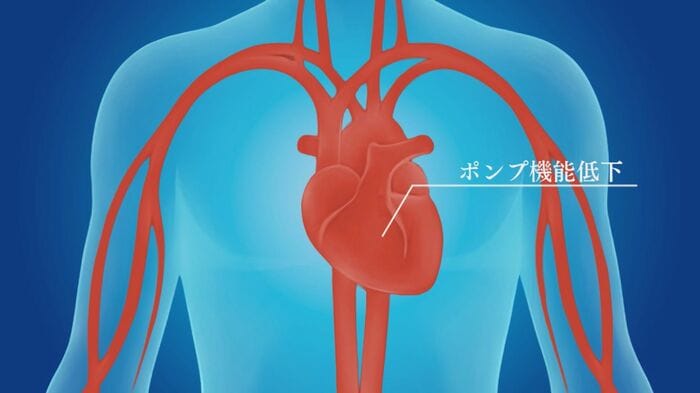 「重症心不全」イメージCG