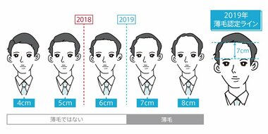 その髪の状態は要注意!? 令和版薄毛の境界線 薄毛認定ラインは「眉上7cm」