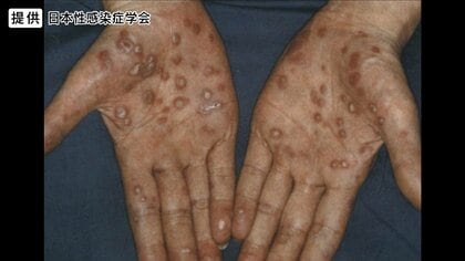 都内の梅毒患者数が3209人に　感染者数は性風俗業従事者が約2割・一般人に広く蔓延か　エイズも去年より増加　東京都