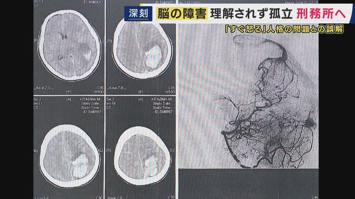 脳損傷を示す写真