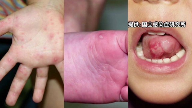 手足口病　提供：国立感染症研究所