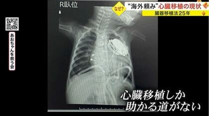 心臓移植しか助かる道がない」臓器移植法施行25年 “海外頼み”増え