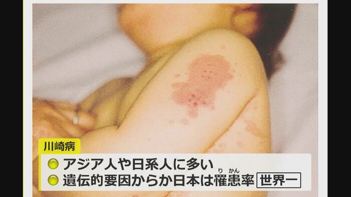川崎病
