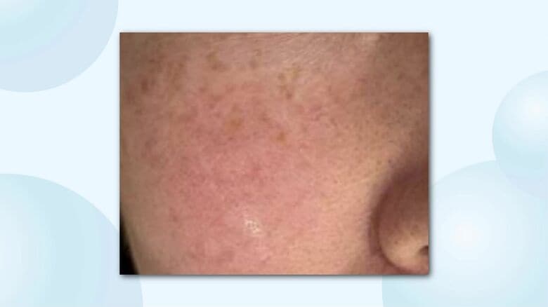 弱った肌に紫外線は大きなダメージ