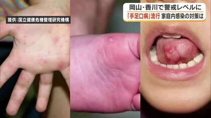 大人も注意！全国的に流行「手足口病」岡山・香川でも警報レベル上回る　夏休み中の家庭内予防を医師に聞く