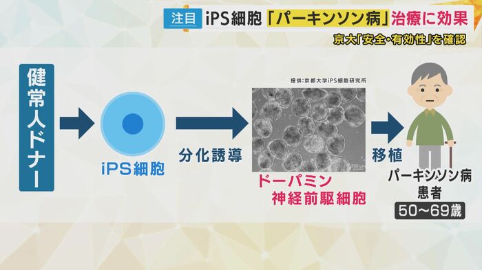 iPS細胞を使ってドーパミンを出す神経細胞を作り患者の脳に移植