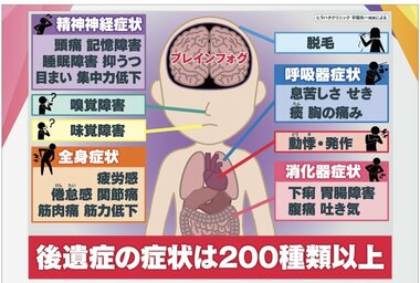 ブレインフォグ「脳に霧」 “コロナ後遺症” 感染1年後も頭痛や倦怠感