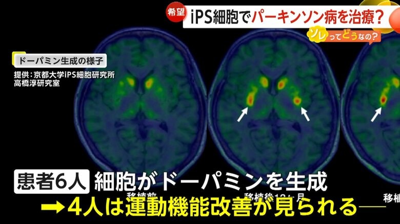 「難病の概念が変わるような第一歩」iPS細胞でパーキンソン病改善か？京都大学が治験成果発表　患者7人中4人が“運動機能改善”・重い副作用もなし｜FNNプライムオンライン