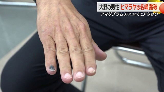 手足の指20本が凍傷と診断